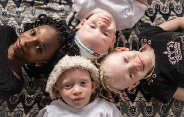 Sinasra continues to advocate for people with albinism