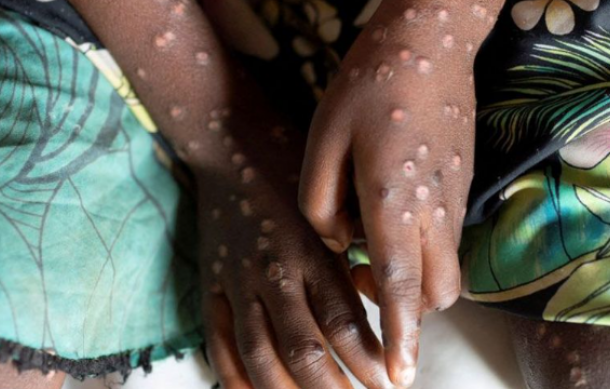Zambia records 1,299 suspected MPOX cases and three deaths