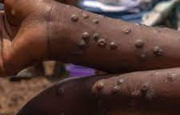Zambezi health on alert over Mpox, Cholera in Zambia